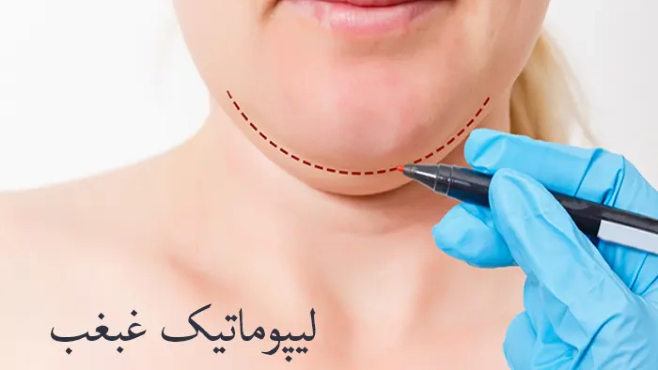لیپوماتیک غبغب بانوان